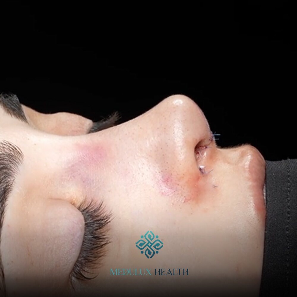 Before and After Result